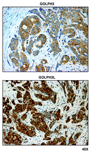 Figure 2. GOLPH3 and GOLPH3L, markers of mitochondrial lipid biosynthesis, are localized mainly to epithelial cancer cells in human breast cancer tissues. Paraffin-embedded sections of human breast cancer tumor tissue were immunostained with antibodies directed against GOLPH3 and GOLPH3L. Slides were then counter-stained with hematoxylin. Note that both GOLPH3 family members are largely absent from the stromal compartment and confined to the epithelial compartment (brown color). Original magnification is 40x, as indicated.