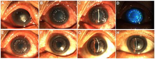 Figure 6 Another successful graft transplantation in the infectious central corneal ulcer group. (A–D) Before surgery (A) and at 1 day (B), 7 days (C and, D), 1 month (E), 3 months (F), 6 months (G), and 12 months (H) postoperatively.