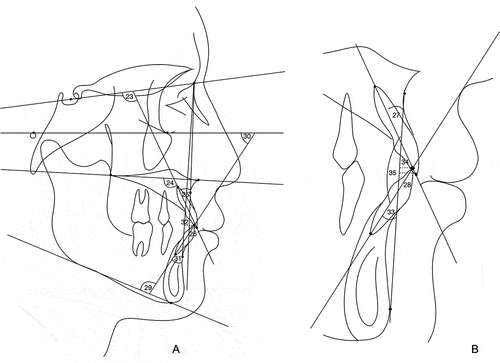 Figure 3. The dental cephalometric measurements. 23. U1-SN, 24. U1-PP, 25. U1-NA, 26. U1-NA, 27. U1-APg, 28. U1-APg, 29. IMPA, 30. FMIA, 31. L1-NB, 32. L1-NB, 33. L1-apg, 34. L1-apg, 35. Interincisal angle.