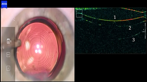 Figure 1 Detachment of the anterior vitreous membrane after intraocular lens implantation (intraoperative OCT).