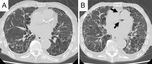 Figure 2 Computed tomography (CT) images of the chest of an 89-year-old man with idiopathic pulmonary fibrosis (IPF). CT performed 1 year ago revealed reticular opacities and honeycombing in peripheral areas of both lungs consistent with IPF (A). A CT scan performed on admission revealed that the reticular opacities and honeycombing were exacerbated (B). Pneumomediastinum appeared around the pulmonary artery (arrows); however, no enlargement of the mediastinum was observed.