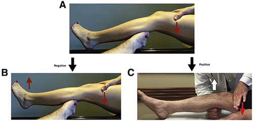 Figure 1 The proper technique for performing the lever sign test is shown in picture (A). Picture (B) Depicts the test technique with a negative test result, while Picture (C) Depicts the test technique with a positive result.