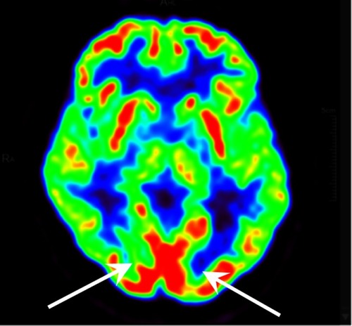 Figure 9 PET-CT image of a normal person. Two white arrows show the normal metabolism of primary visualcortex.