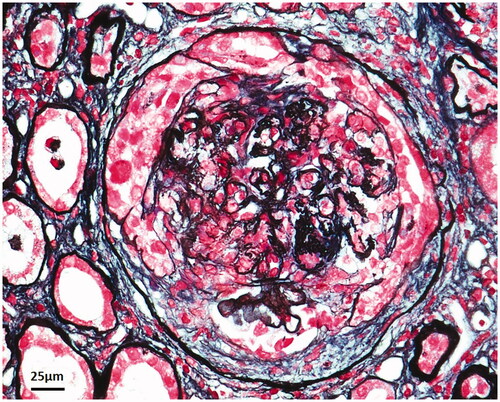 Figure 1. Renal pathology of patient 3 with post-extracorporeal shock wave lithotripsy (ESWL) anti-GBM disease showed cellular crescent formation in a glomerulus by periodic acid-silver methenamine and Masson trichrome stain on light microscopy (400×).