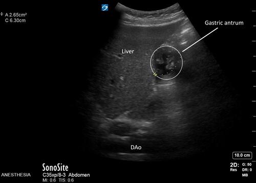 Figure 1 Preoperative point-of-care gastric ultrasound in the supine position 3 hours after discontinuation of the polyethylene glycol solution. The gastric antrum is observed next to the left lobe of the liver with a target sign, which suggests an empty stomach. DAo, descending aorta.