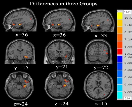 Figure 1 ReHo maps showing significant differences among the three groups displayed on axial, coronal, and sagittal slices. Numbers indicate x, y, and z slices, and are displayed in MNI coordinates. Red colors denote increased activity. The color bars indicate the F-value based on one-way ANOVA. (p<0.01 AlphaSim correction).