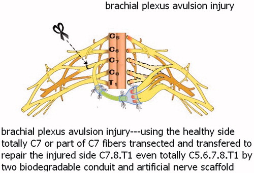 Figure 3. This new operation technique for brachial plexus injury to restore the function of distal elbow and hand.