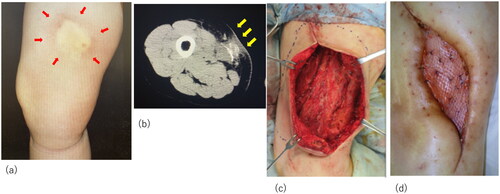 Figure 1. Initial examination and surgery of the patient. (a) The initial lesion of the thigh; arrows indicate the indurated nodule. (b) Computed tomography images indicating calcification and inflammation. Arrows indicate the calcification. (c) Intraoperative view of the thigh after radical debridement. (d) Successful placement of the skin graft.