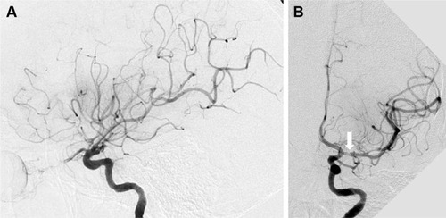 Figure 4 Left internal carotid artery angiogram (lateral [A], and anteroposterior [B] views) showing recanalization (Thrombolysis in Cerebral Infarction [TICI] scale grade IIb), and slight vasospasm (white arrow) of the left middle cerebral artery following mechanical thrombectomy.