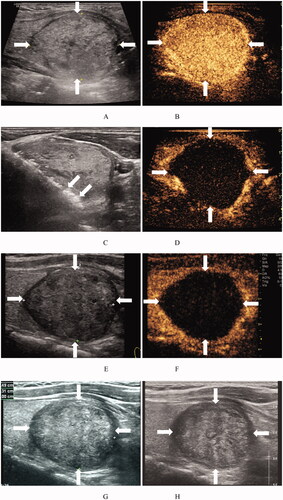Figure 3. Ultrasound images of a 31-year-old woman with a BTN before and after MWA. (A) Before MWA, an ultrasound image reveals a solid iso-echoic nodule (arrows), with a nodule volume of 23.06 mL. (B) Before MWA, the nodule shows hyper-enhancement (arrows) on CEUS images of the early phase. (C) Ultrasound image shows insertion of the needle (arrows) into the nodule and appearance of a hyperechoic ablation zone (arrows) during MWA. (D) Immediately after MWA, the ablation zone (arrows) shows no enhancement on CEUS images. (E) At 1 month after MWA, an ultrasound image reveals that the volume of the ablation zone (arrows) has decreased to 14.93 mL (VRR = 35.3%). (F) At 1 month after RFA, the ablation zone (arrows) shows no enhancement on CEUS images. (G) At 1 year after MWA, an ultrasound image reveals that the volume of the ablation zone (arrows) is 12.16 mL (VRR = 47.2%). (H) At 1.5 years after MWA, the volume of the ablation zone (arrows) is 12.16 mL (VRR = 47.2%). BTN: benign thyroid nodule; MWA: microwave ablation; CEUS: contrast-enhanced ultrasound; VRR: volume reduction ratio.