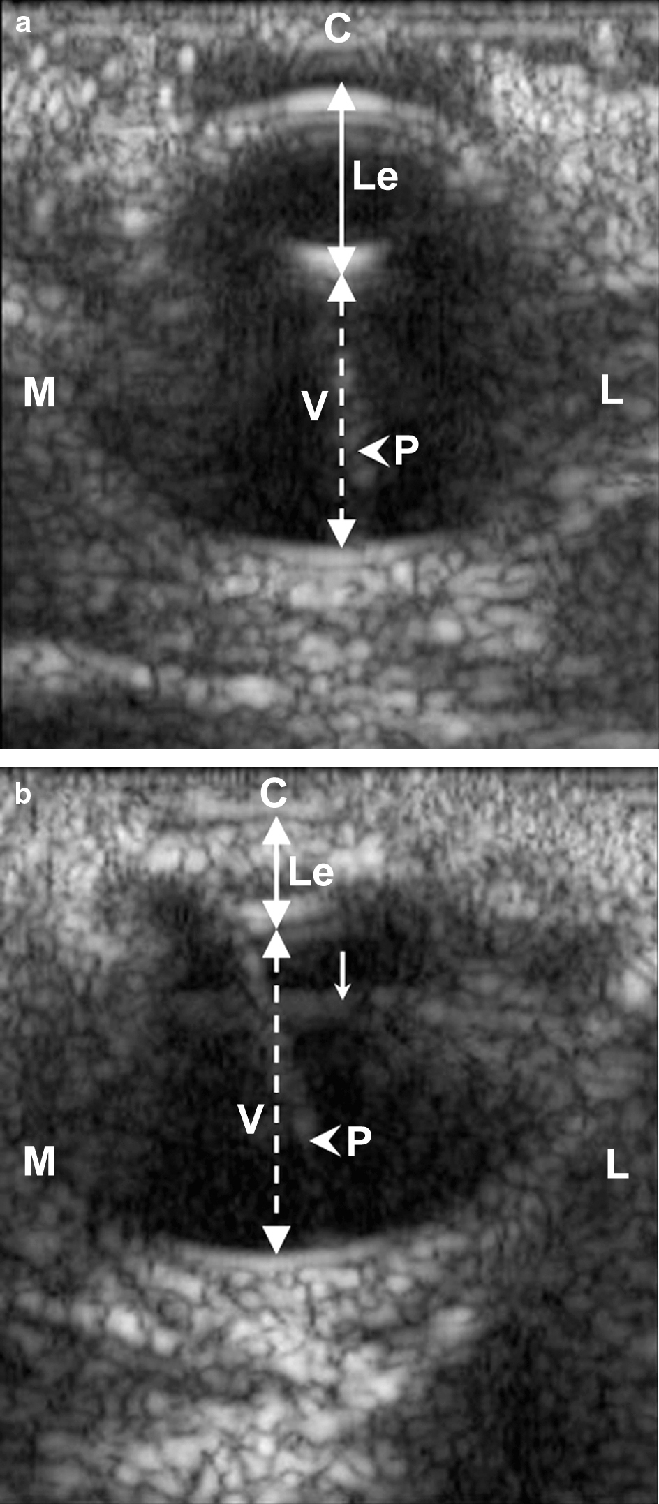 Figure 1.  Ultrasonographic photography of the eye of a 3-week-old affected animal (1b) and its control (1a). In the affected animal, an abnormal hyperechogenicity in the lens cortex and a microphakia are detectable when compared with the control. C, cornea. Le, lens; V, vitreous, Continuous doubleheaded arrow, antero-posterior axis of the lens; discontinuous doubleheaded arrow, antero-posterior axis of the vitreous; arrowhead, with pecten (P); thin arrow, probe-related artefact. M, medial; L, lateral. B-scan/10 MHz.