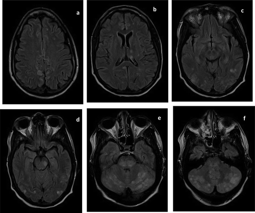 Figure 1. Fluid-attenuated inversion recovery (FLAIR) magnetic resonance images (MRI) at presentation showed scattered regions of hyperintense signal in the frontal, parietal, occipital, and temporal lobes bilaterally (a–d). FLAIR hyperintensities are also seen in the deep grey nuclei (b), midbrain (d–e), and cerebellum (e–f).