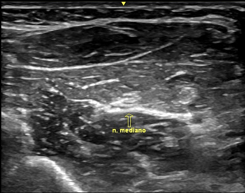 Figure 1 Use of ultrasound to locate the median nerve for the application of the percutaneous neuromodulation intervention.