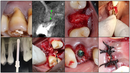 Figure 1 DIHSFE (Drill Integrated Hydrodynamic Sinus Floor Elevation) - Test group. (A) Periodontally compromised tooth. (B) CBCT showing deficient native bone and vertical root fracture. (C) Atraumatic extraction showing the intact interradicular bone. (D) DIHSFE technique performed with the insertion of hydrodynamic drills. (E) IOPA showing the breaching of sinus floor with drill integrated hydrodynamics. (F) Autologous fibrin integrated ẞ-TCP (Sticky bone) for sinus augmentation. (G) Immediate implant placement and jumping distance between the socket and the implant, as well as the adjoining sockets was also grafted with the fibrin integrated ẞ-TCP (Sticky bone). (H) A-PRF was laid over followed by flap approximation and sutured.