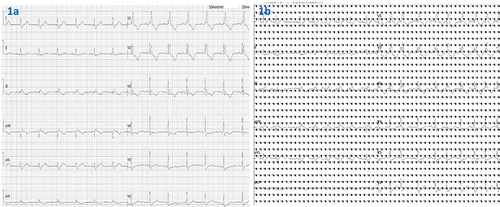 Figure 1 Electrocardiogram images showed changes in electrocardiogram during the course of the disease. (a) Electrocardiogram of the patient before immunotherapy. (b) Electrocardiogram of the patient after seven weeks of immunotherapy: Appeared tachycardia, complete right bundle branch block, and abnormal ST-T segment.