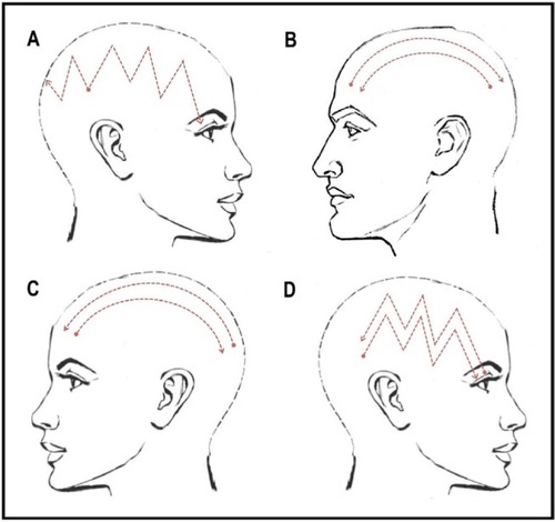 Figure 1 Trajectory of pain paroxysms in our four patients. (A) Parietal to occipital area and parietal area to the eye (right side). (B) Occipital area to the forehead (right and left sides). (C) Occipital area to the forehead (left side). (D) Parietal area to the eye (right side).