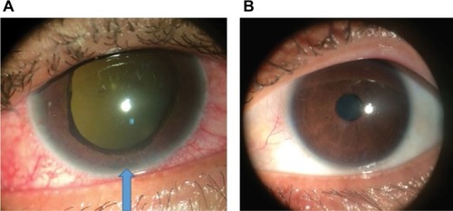 Figure 3 Right eye showed rubeosis iridis with ectropion uvea and hypopyon (blue arrow) (A) and mild anterior segment inflammation in the left eye (B).