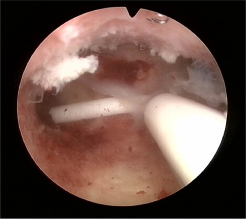 Figure 11 Mirena: shortened transverse arm after removal because of patient complaints and reinsertion under strict sterile conditions.