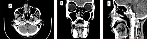 Figure 2 Axial (A) coronal (B) and sagittal view (C) of contrast CT of para-nasal sinus.