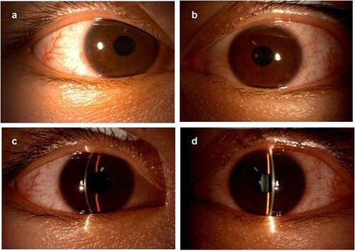 Figure 4. Slit-lamp examination photos on the fourteenth day after the third dose of COVID-19 vaccination.