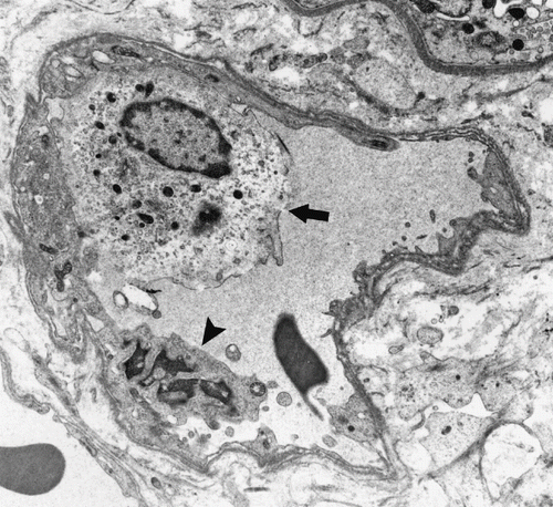 Figure 2. MN cell in PCs (arrow) and an apoptotic endothelial cell (arrowhead) (Uranyl acetate, lead citrate 3597X).