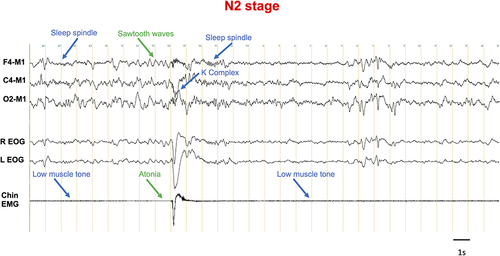 Figure 1 Intra-Epoch Heterogeneity In Sleep Stages. In this N2 epoch, one can see both N2 features (in blue: low muscle tone, K complex, sleep spindles) and R features (in green: sawtooth waves and transient atonia). This example highlights that the 30s scale does not capture the complexity of the dynamics of vigilance states.