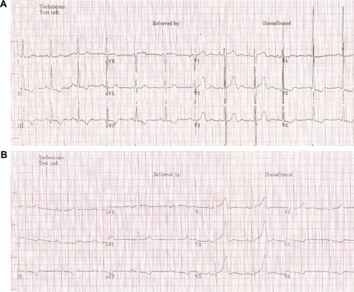 Figure 1 Electrocardiogram on admission and after stent implantation.Notes: (A) Showing ST segment slope-down depression and T-wave inversion in leads II, III, aVF, and V4–V6; (B) ECG after stent implantation. T-wave amplitudes in leads II, III, aVF were decreased, compared with (A).Abbreviation: ECG, electrocardiogram.