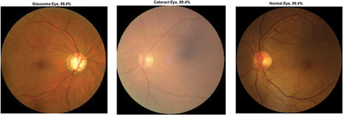 Figure 8. Ocular disease classification using SqueezeNet (batch size-6, optimizer-Adam) (with augmented image data).