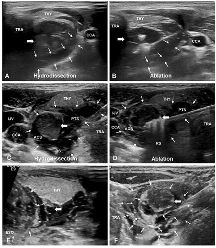 Figure 2. Ultrasound images of traditional hydrodissection and improved hydrodissection. (A) Traditional hydrodissection before ablation. A narrow anechoic isolating band (white thin arrows) was established outside the SHPT lesion (white thick arrow) by one-time injection. (B) During ablation, the isolating liquid (white thin arrows) was absorbed and diffused over time, there was no sufficient separating distance. (C) Improved hydrodissection before ablation. The pretracheal space (PTS), the retropharyngeal space (RS) and the anterior cervical space (ACS) were hydrodissected. The isolating fluid formed an anechoic isolating band (white thin arrows) and separated SHPT lesion (white thick arrow) as an ‘island’. (D) During ablation, the thickness of isolating band (white thin arrows) was maintained at least 5mm through continuous injection of NS. (E) Improved hydrodissection in the TGS (thin white arrows), which shows as a semicircular multilayer mixed-echoic area. (F) Improved hydrodissection in the CPS (thin white arrows). After injection of NS, the ‘onion skin’ sign emerged around SHPT lesion (white thick arrow), which showed a multiple layer and annular anechoic area. Note: THY, thyroid; ESO, esophagus; TRA, trachea; CCA, common carotid artery; IJV, internal jugular vein; CPS, circumferential periparathyroidal space; TGS, tracheoesophageal groove space = TGS.