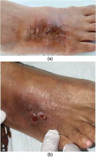 Figure 1. (a) An indurated purplish plaque surmounted by papules and nodules on the dorsum of the right foot, sometimes ulcerated. (b) Violaceous papules and nodules with a sero-purulent discharge.