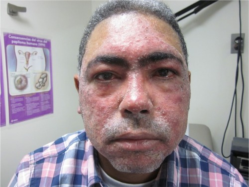 Figure 4 Ocular rosacea.