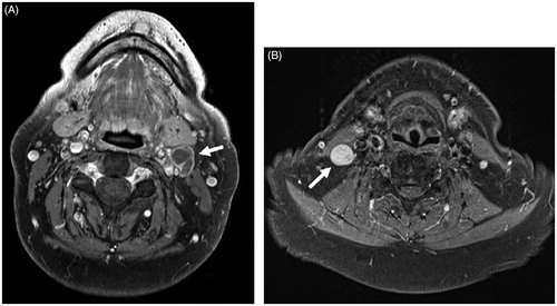 Figure 3. Axial T1-weighted, fat-suppressed contrast-enhanced MR images. (A) The presence of central necrosis in level II lymph node (arrow in A) was considered a definitive sign of malignancy. (B) A markedly enlarged and rounded level III lymph node (arrow in B). By size criteria, this node was considered malignant in OTSCC patient. MR: magnetic resonance; OTSCC: oral tongue squamous cell carcinoma.