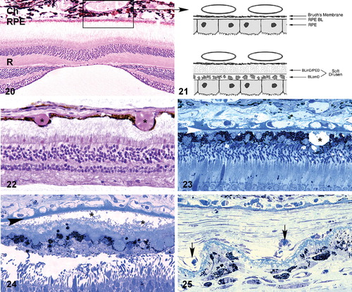 Figures 20–25. Light microscopic(Figures 20, 22–25) and schematic (Figure 21) images depicting the choroid‐RPE‐retina interface. A section showing the normal anatomical relationships of the macular choroid (Ch), retinal pigmented epithelium (RPE) and neural retina (R) is shown in Figure 20; the section passes directly through the foveal pit. The boxed region corresponds to that depicted in Figure 21, which compares the choriocapillaris‐RPE interface in unaffected (top) and affected (bottom) individuals. The majority of early age‐related macular degeneration (AMD)‐associated extracellular lesions–‐including drusen, basal laminar deposit (BLamD), and basal linear deposits (BLinD)–‐form along this interface. Drusen (asterisks), which form between the RPE and Bruch's membrane, are present in Figures 22 and 23. Extensive accumulations of BLamD (asterisks), which form between the RPE and its basal lamina, are depicted in Figure 24. Choroidal neovessels, located in both the sub‐RPE and subretinal spaces (arrows) are shown in Figure 25. Arrowheads in Figures 23 and 24, Bruch's membrane.