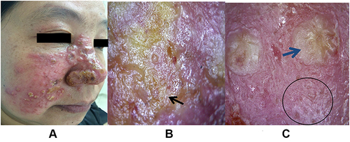 Figure 1 Prior treatment: picture taken at the clinic shows nonhealing, infiltrating erythema, umbilical concave papules and pustules on the right side of the face and nose (A); dermoscopy revealed generalized erythema, a yellowish, structureless area ((B), dark arrow), clustered pustules ((C), blue arrow), which resemble fried eggs on a dark red background, and vellus hair loss ((C), dark circle).