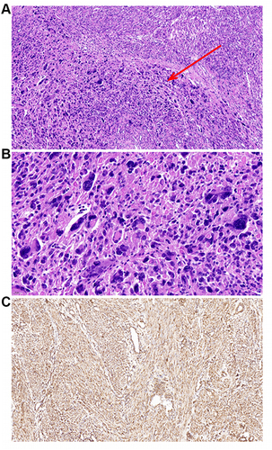 Figure 1 Classic morphological characteristics of leiomyoma with bizarre nuclei (LBN). (A) The bizarre cells shows a patchy distribution in a background of typical leiomyoma (red arrow). (B) The bizarre cells can be mononucleated or multinucleated and have eosinophilic or globular cytoplasm, spindled or elongated nuclei, irregular nuclear membrane, and smudgy chromatin. (C) Immunohistochemical staining shows positive expression of FH in tumor cells.
