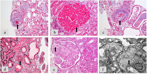 Figure 2. The classic renal pathological lesions of C-TMA. Arrows pointed to typical changes. (a) Arteriole thrombi (Masson’s trichrome staining, ×400). (b) Glomerular thrombi (Hematoxylin and eosin (H&E) staining, ×400). (c) Subintimal myxoid edema of artery (Masson’s trichrome staining, ×400). (d) Onion skin lesion of arteriole (Periodic Acid-Silver Methenamine and Masson’s trichrome staining). (e) Glomerular endothelial swelling, proliferation, and double contour formation (Periodic acid-Schiff staining, ×400). (f) Subendothelial edema of glomeruli by electron microscopy (×8000).