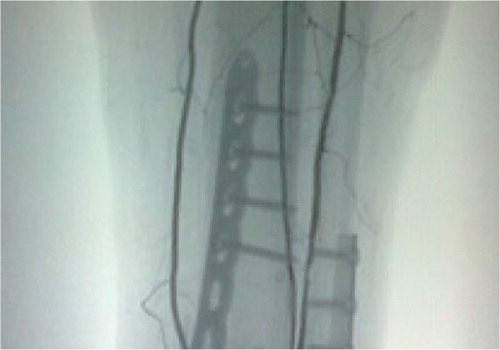 Fig. 5 Postoperative angiography showing partial obstruction of the fibular artery.