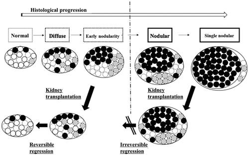 Figure 1. Hypothesized mechanism of THPT in kidney transplant recipients. Diffuse hyperplastic glands undergo reversible regression after kidney transplantation, while nodular hyperplastic glands show irreversible changes that do not regress. This state in nodular hyperplastic glands is attributed to decreased densities of various parathyroid cell receptors (vitamin D receptors, calcium-sensing receptors, FGF23 receptors, etc.).