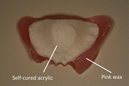 Figure 10 Maxillary occlusal rim.