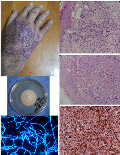 Figure 1 Clinical aspect and biopsy of phaeohyphomycosis patient and the culture of Paraconiothyrium cyclothyrioides. (A)The clinical aspect of the patient, is crusted, ulcerated plaque on the right opisthenar and several macular papules and nodules on the erythematous plaque. (B–D) Biopsy specimens revealed pseudoepitheliomatous hyperplasia and suppurative granulomas, and fungal elements were seen invading the dermis by PAS and GMS (×400). (E) Culture of the tissue specimens yielded a one colony type mold. (F) Microscopic morphology showed septate, bamboo-like hyphae, and no spores were found (×400).