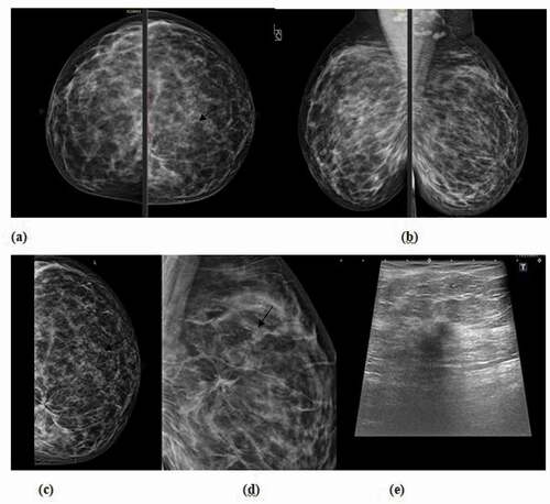 Figure 2. 49 years old case, with positive family history of breast cancer, presented for screening mammography (a) Craniocaudal and (b) Medio lateral oblique DM images of both breasts revealed suspected distortion noted at the inner portion of the left breast. (c) and (d) Craniocaudal and mediolateral oblique Tomosynthesis revealed an area of suspicious architectural distortion.(e) Ultrasound revealed an ill-defined hypo-echoic mass lesion with posterior shadowing. US guided core biopsy was performed and revealed infiltrating ductal carcinoma