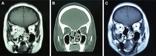 Figure 5 Representative imaging scans of a patient with right ethmoid sinus rhabdomyosarcoma.