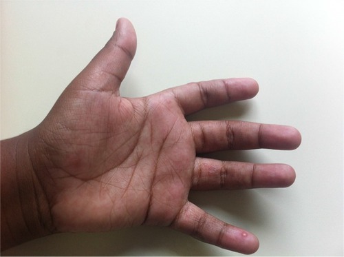 Figure 4 Vesicles on erythematous base on the side of fingers.