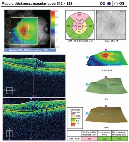 Figure 3 Optical coherence tomograph for a patient in group 2 at the preoperative visit.