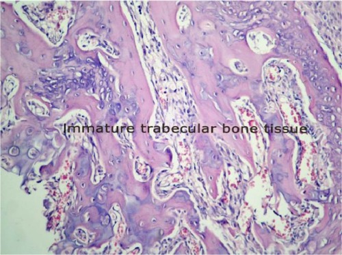 Figure 4 Histopathological sample of bone tissue. The sample shows mostly immature bone tissue.