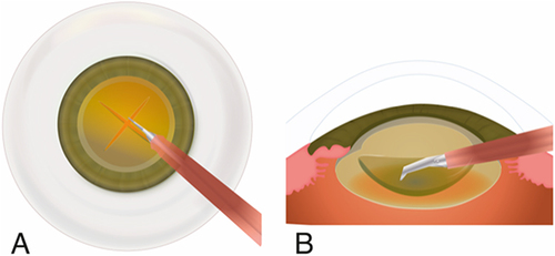 Figure 2 (A) The ultrachopper phaco-tip was employed to achieve two perpendicular slim grooves in the nucleus allowing four quadrant formation. (B) Lateral view of the nucleus groove sculpting employing the ultrachopper.
