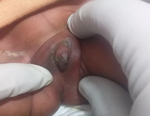 Figure 2 Enlarged phallus and fusion of labia minora with the base of clitoris and no vaginal orifice.