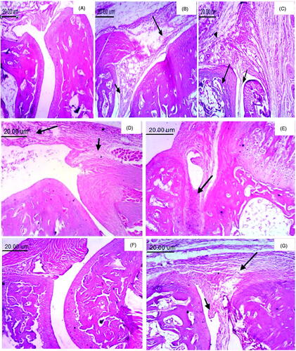 Figure 7. Photomicrographs of paw tissue (H & E, 100×). (A) Normal group, showing two articular cartilages separated by normal joint space with normal synovial membrane. (B) Inflamed group, showing pannus formation (small arrow) and marked edema (large arrow). (C) Inflamed irradiated, showing pannus formation (small arrow), necrosis of cartilage (large arrow) and edema with inflammatory cells infiltration (arrowhead). (D) Inflamed irradiated group treated with blank hydrogel, showing edema (small arrow) and inflammatory cells infiltration (large arrow). (E) Pure tenoxicam (TNX) hydrogel showing the accumulation of inflammatory exudate (arrow). (F) Tenoxicam-nanostructured lipid carriers (TNX-NLCs) hydrogel, showing no histopathological changes. (G) Oral TNX, showing pannus formation (small arrow) and edema (large arrow).