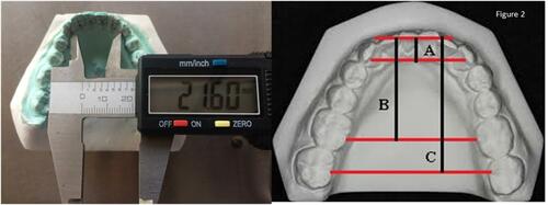 Figure 2 Measurement of lingual arch dimensions. (A) Canine depth. (B) First molar depth. (C) Second molar depth.