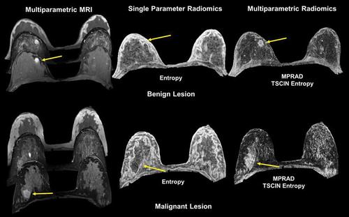 Figure 9. Illustration of multiparametric radiomic feature maps obtained from single and multiparametric radiomic analysis in a benign and malignant lesion. Top Row: Example of a patient with a benign lesion, where the straight yellow arrow highlights the lesion. There are clear differences between the single and multiparametric entropy radiomic images, where the multiparametric clearly demarcates the lesion. Bottom Row: Similar analysis on a patient with a malignant lesion (yellow arrow). Again, the multiparametric entropy map improves tissue delineation between the glandular and lesion tissue.
